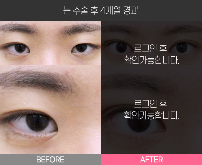 눈 수술 후 4개월 경과