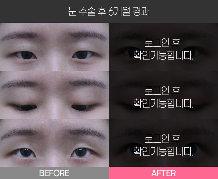 눈 수술 후 6개월 경과