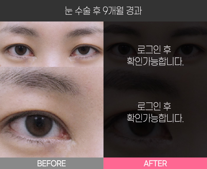 눈 수술 후 9개월 경과