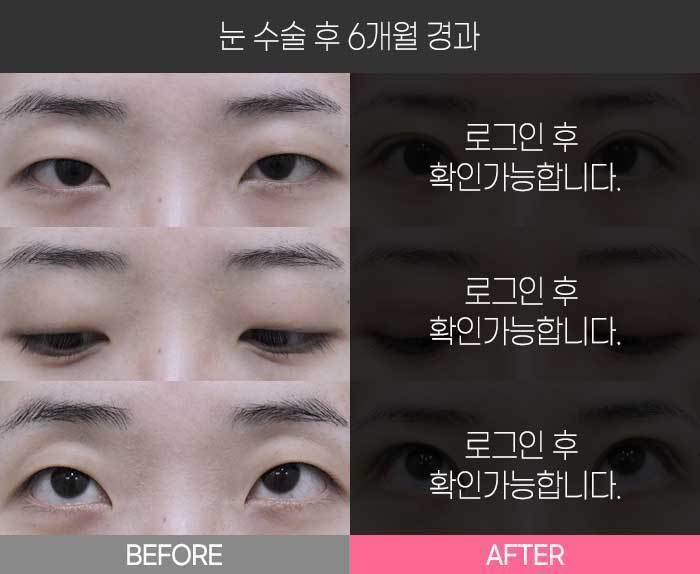 눈 수술 후 6개월 경과