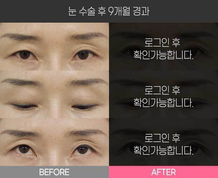 눈 수술 후 9개월 경과