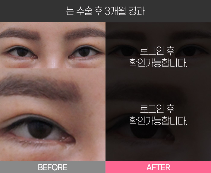 눈 수술 후 3개월 경과
