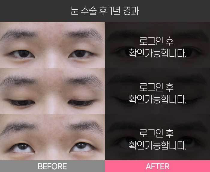 눈 수술 후 1년 경과