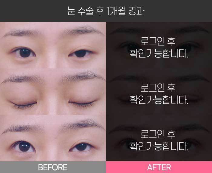 눈 수술 후 1개월 경과