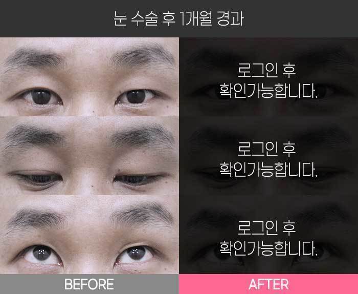 눈 수술 후 1개월 경과