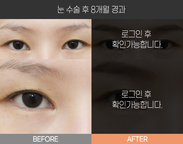 눈 수술 후 8개월 경과