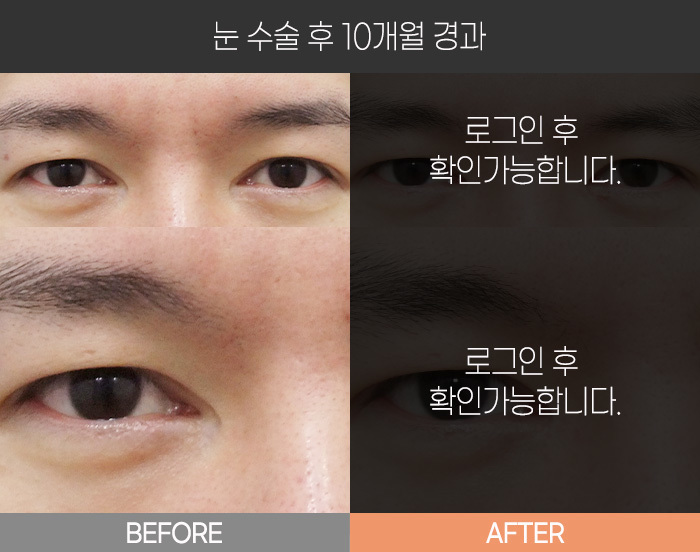 눈 수술 후 10개월 경과