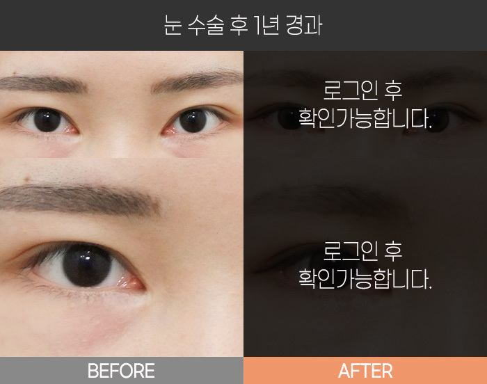 눈 수술 후 1년 경과