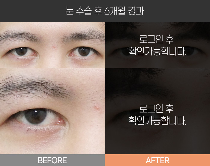 눈 수술 후 6개월 경과