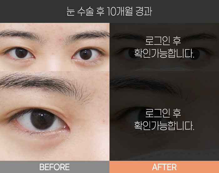 눈 수술 후 10개월 경과