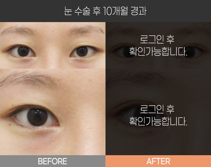 눈 수술 후 10개월 경과