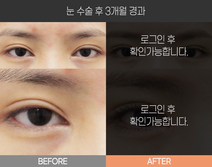 눈 수술 후 3개월 경과
