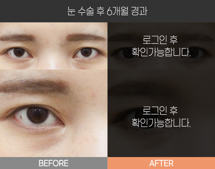눈 수술 후 6개월 경과