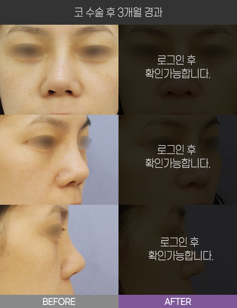코 수술 3개월 경과