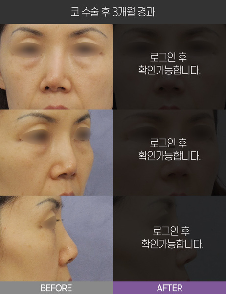 코 수술 3개월 경과