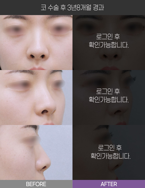 코 수술 3년8개월 경과