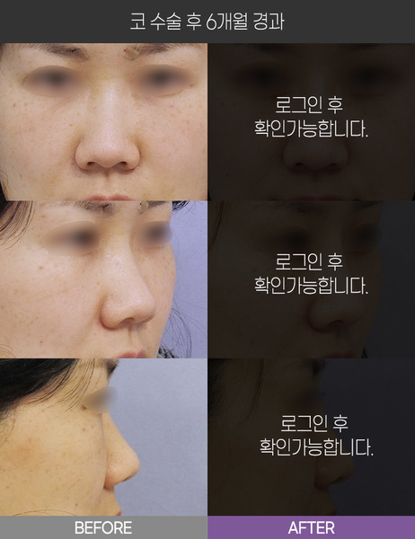 코 수술 6개월 경과