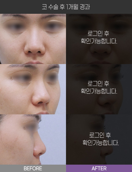 코 수술 1개월 경과