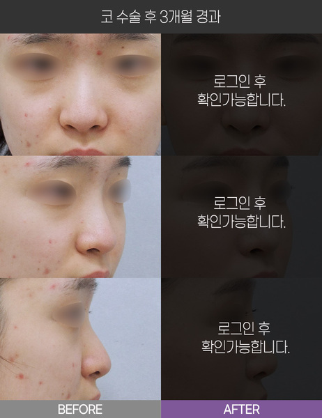 코 수술 3개월 경과