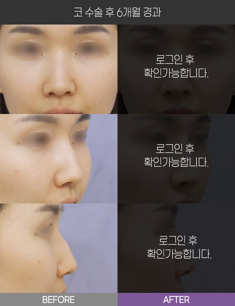 코 수술 6개월 경과