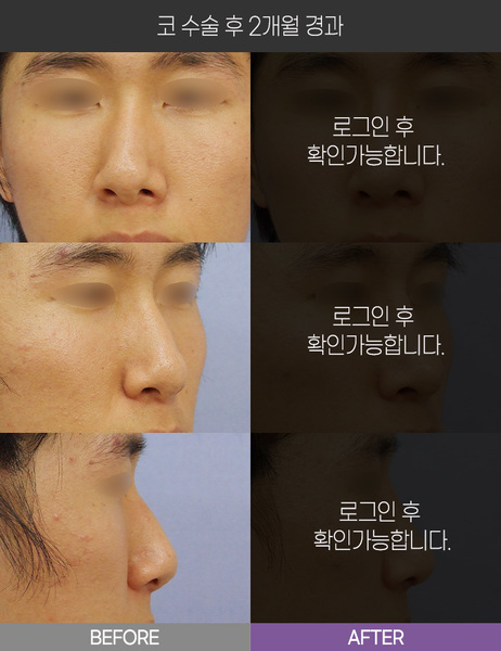 코 수술 2개월 경과