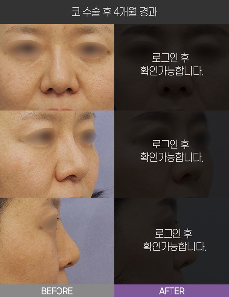 코 수술 4개월 경과