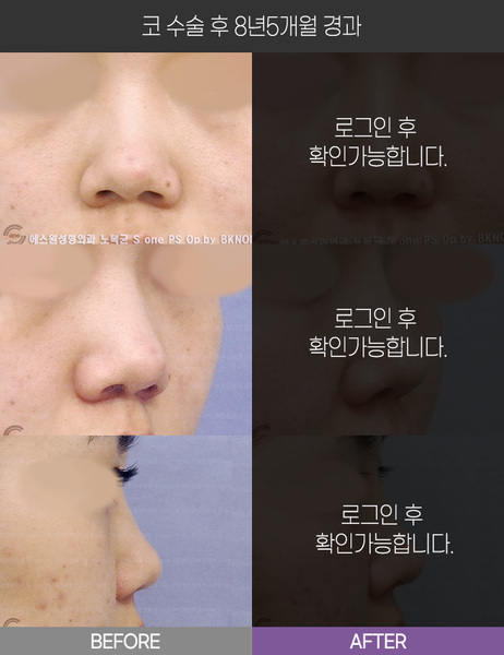코 수술 8년5개월 경과
