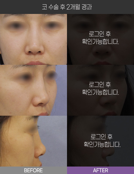 코 수술 2개월 경과