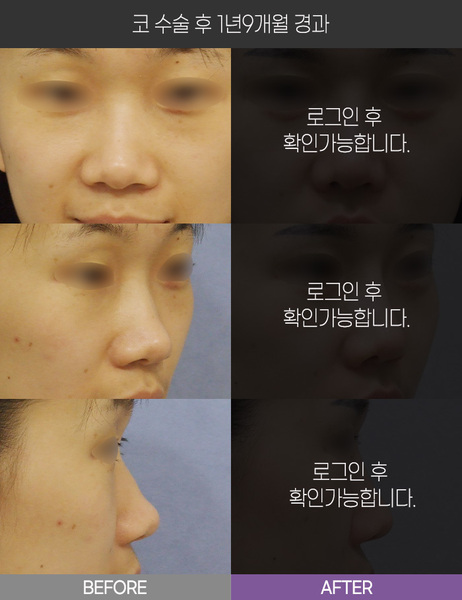 코 수술 1년9개월 경과