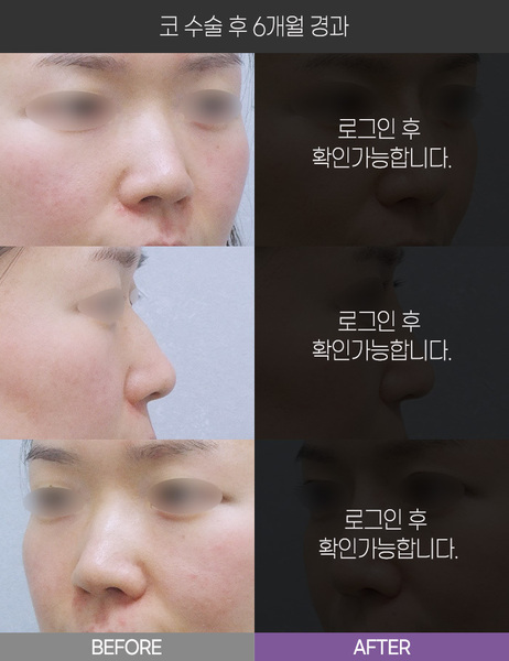 코 수술 6개월 경과