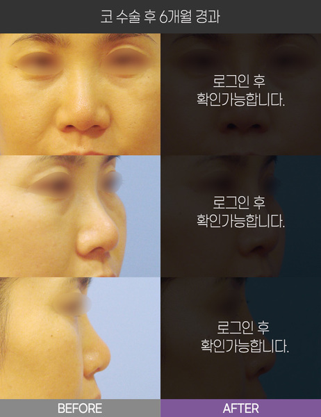 코 수술 6개월 경과