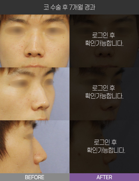코 수술 7개월 경과