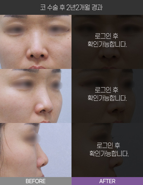 코 수술 2년2개월 경과
