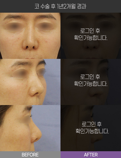 코 수술 1년2개월 경과