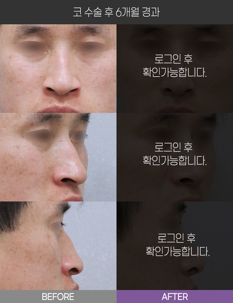 코 수술 6개월 경과