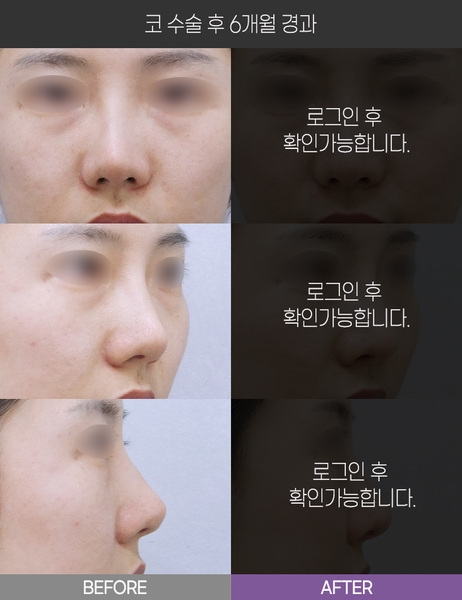 코 수술 6개월 경과
