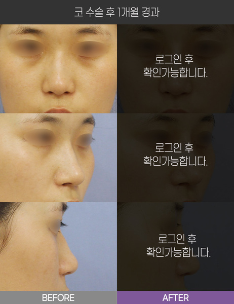 코 수술 1개월 경과