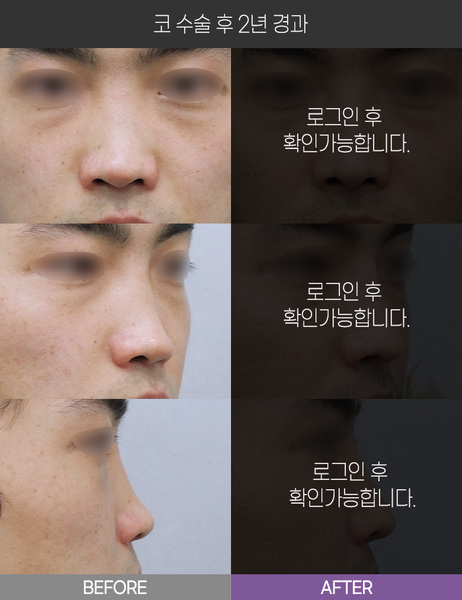 코 수술 2년 경과