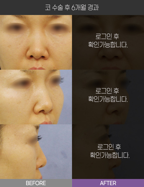 코 수술 6개월 경과