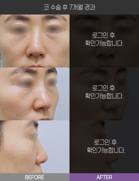 코 수술 7개월 경과