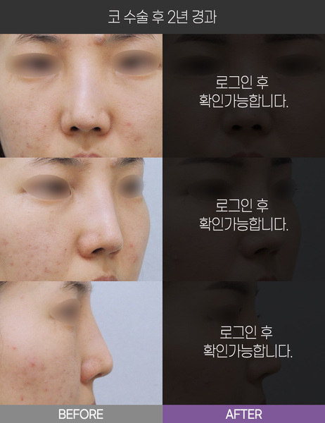 코 수술 2년 경과